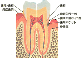 歯周病について 歯周病について